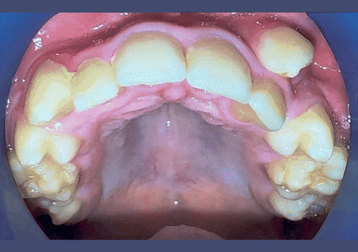 Case 1 orthodontic treatment, view 2