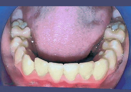 Case 1 orthodontic treatment, view 1