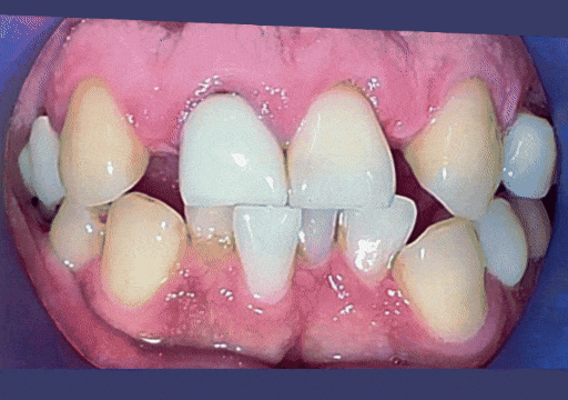 Case 2 orthodontic treatment, view 2