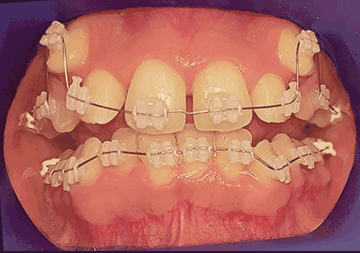 Case 2 orthodontic treatment, view 1