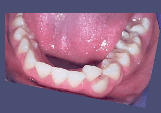 Case 3 orthodontic treatment, view 2