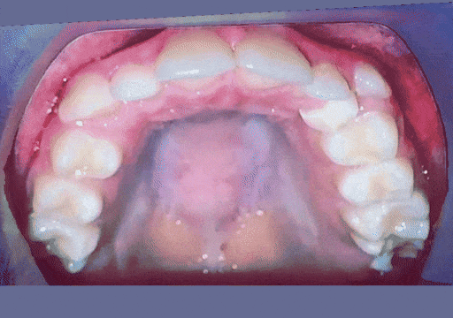 Case 3 orthodontic treatment, view 1