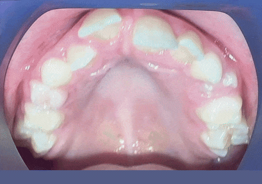 Case 4 orthodontic treatment, upper view