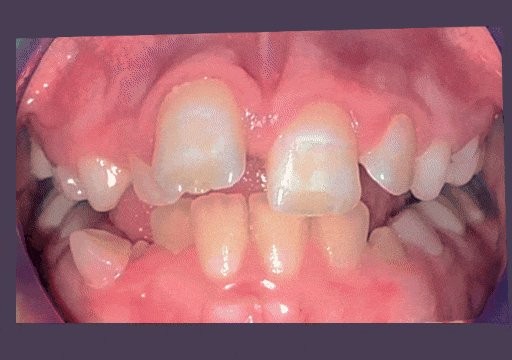 Case 4 orthodontic treatment, center view