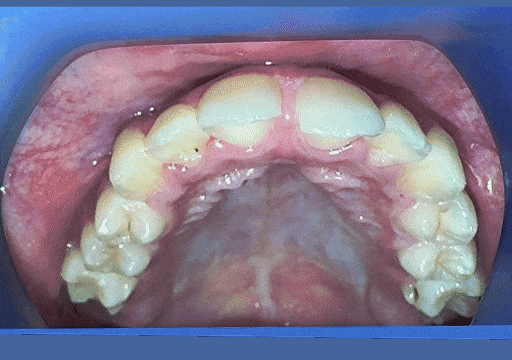 Case 5 orthodontic treatment, upper view