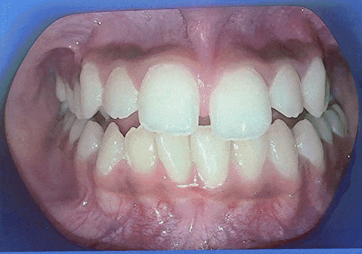 Case 5 orthodontic treatment, center view