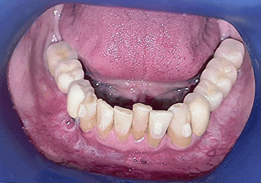 Case 6 orthodontic treatment, lower view
