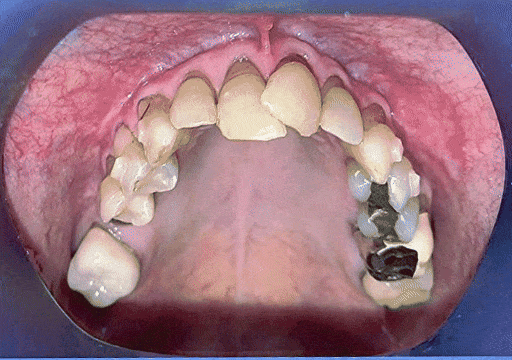 Case 6 orthodontic treatment, upper view