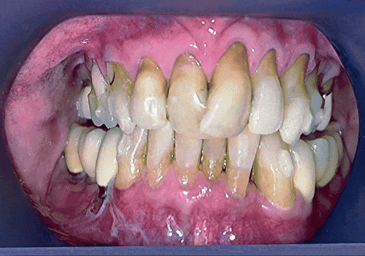 Case 6 orthodontic treatment, center view