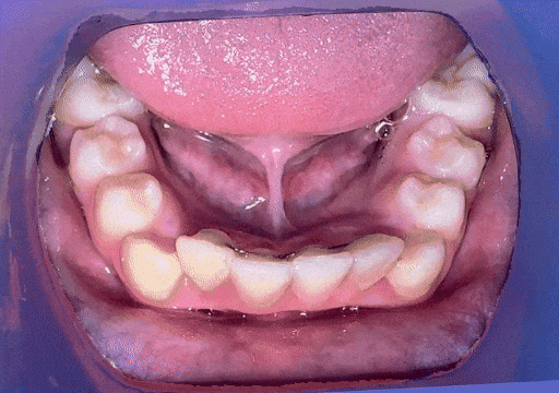 Case 7 orthodontic treatment, lower view