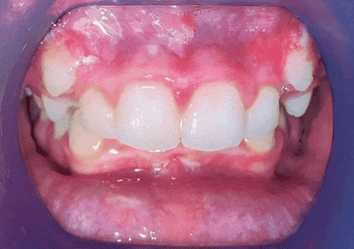Case 7 orthodontic treatment, center view