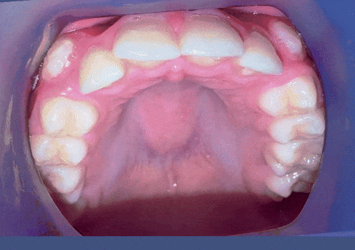 Case 7 orthodontic treatment, upper view