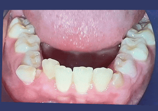 Case 4 orthodontic treatment, lower view