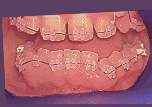 Case 2 orthodontic treatment, lower view