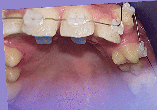 Case 2 orthodontic treatment, view 2