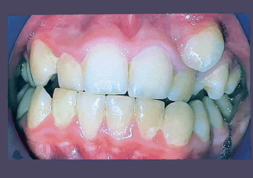 Case 1 orthodontic treatment, center view